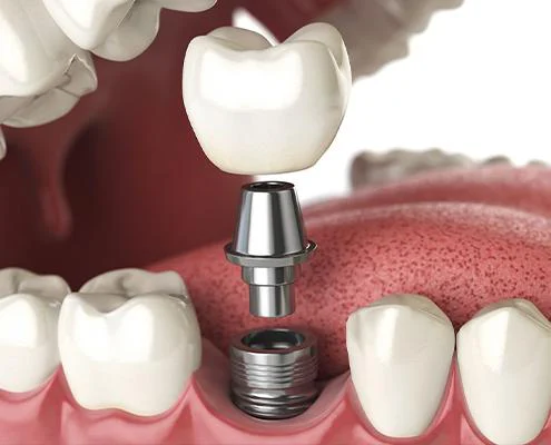 Dental Implants of Morris County 1