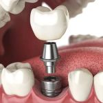 Dental Implants of Morris County