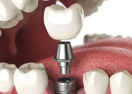 Dental Implants of Morris County