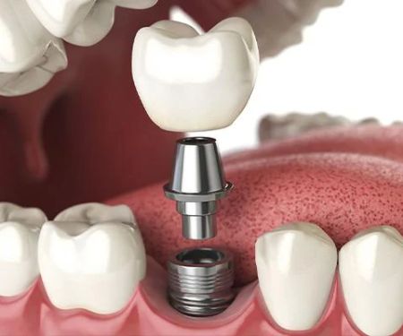 Dental Implants of Morris County