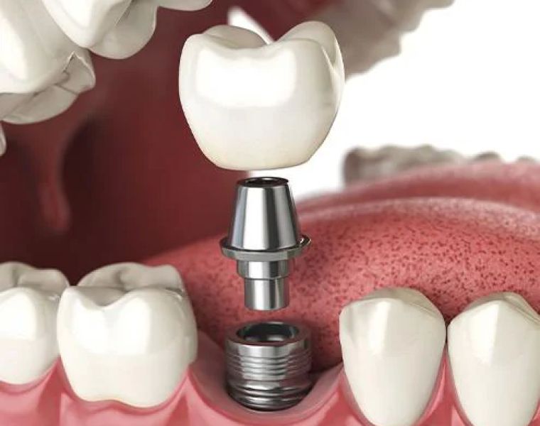 Dental Implants of Morris County