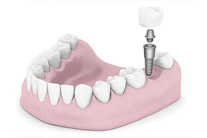 Dental Implants of Morris County 10