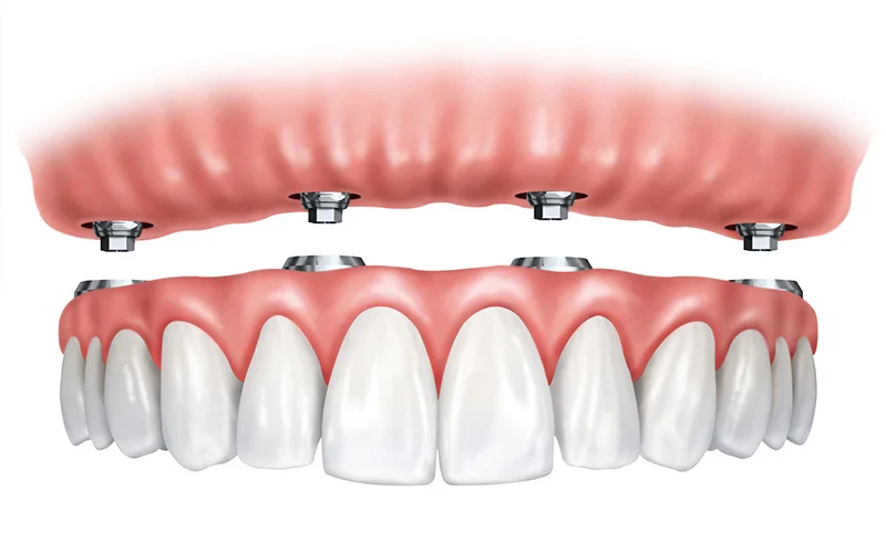 Dental Implants of Morris County 8