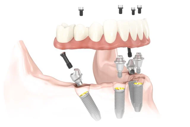 Dental Implants of Morris County 9