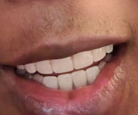 Bala Periodontics and Dental Implants