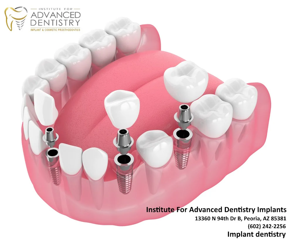 Institute For Advanced Dentistry Implants 3