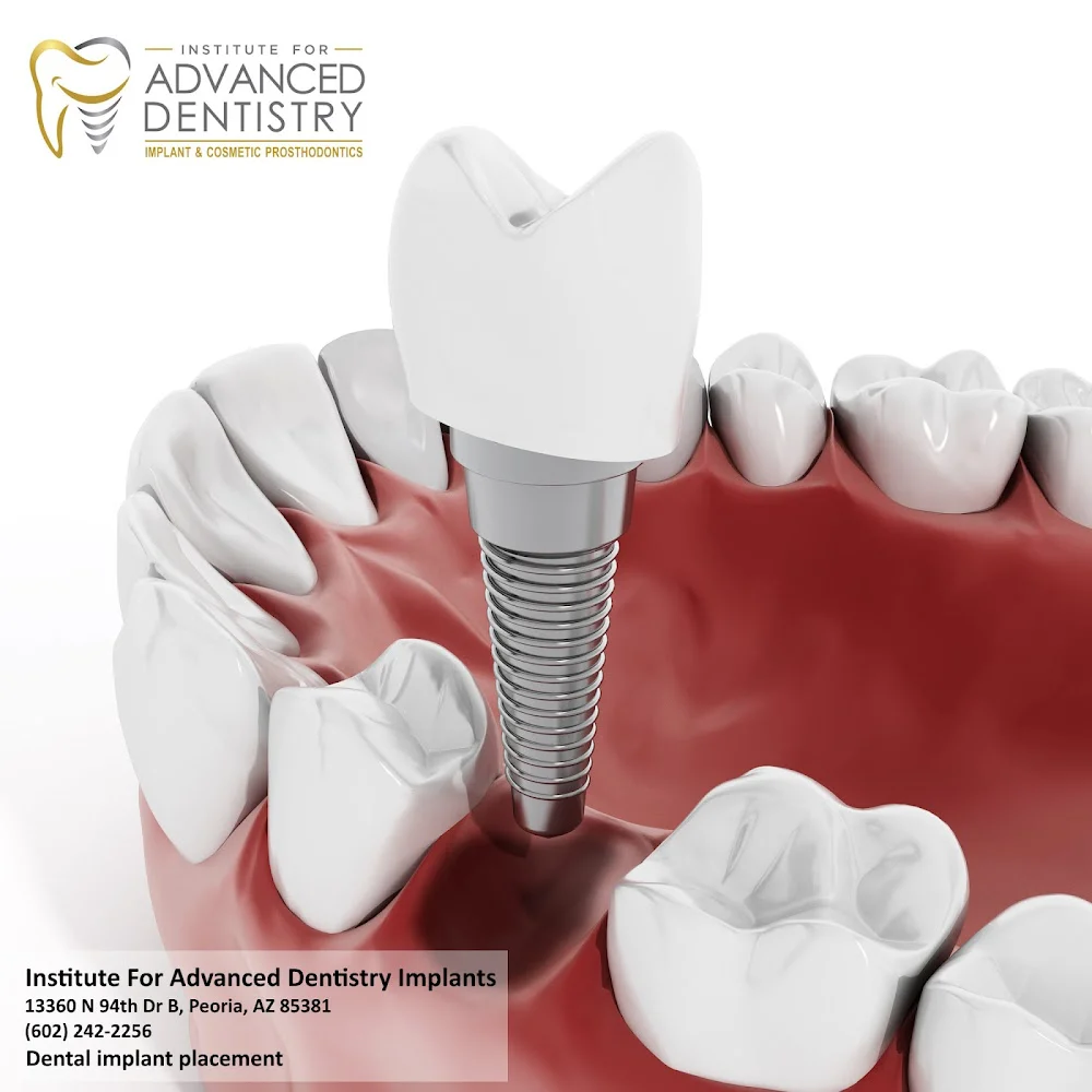 Institute For Advanced Dentistry Implants 8