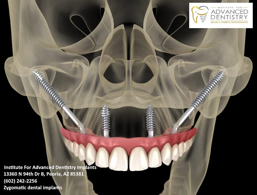 Institute For Advanced Dentistry Implants 9