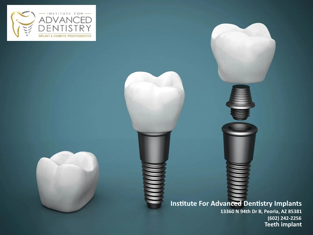 Institute For Advanced Dentistry Implants 10