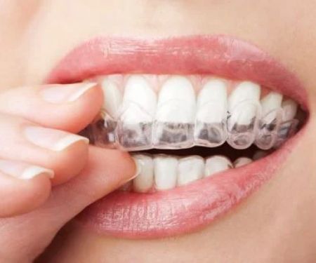 Yang Orthodontics - Invisalign & Braces in Newtown