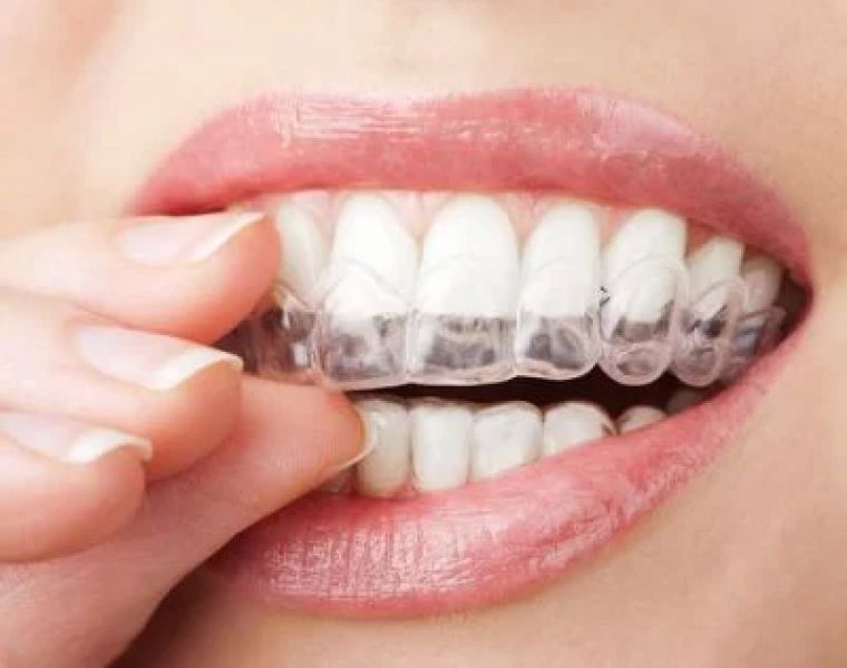 Yang Orthodontics - Invisalign & Braces in Newtown