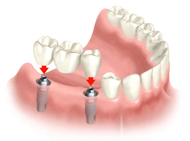 Pennsylvania Center for Advanced Dentistry - Dr. Olga Shvarts 2