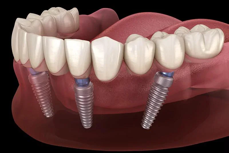 Dental Implants Phoenix 1