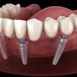 Dental Implants Phoenix
