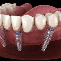 Dental Implants Phoenix ico