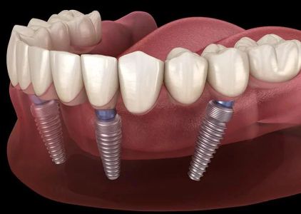 Dental Implants Phoenix
