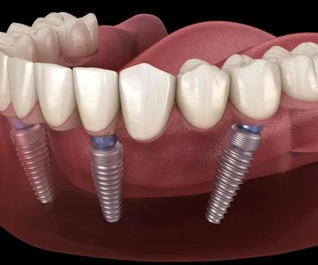 Dental Implants Phoenix