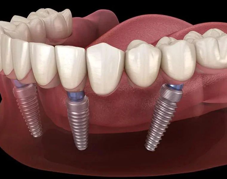 Dental Implants Phoenix