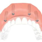 Dental Implant Solutions Kinnelon, NJ