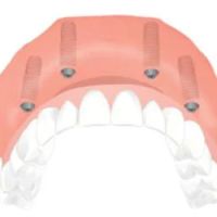 Dental Implant Solutions Kinnelon, NJ ico