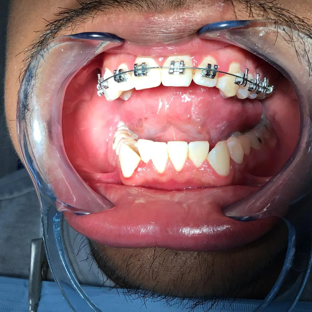 Super Smile Orthodontics - Orthodontist & Invisalign in Corona 4