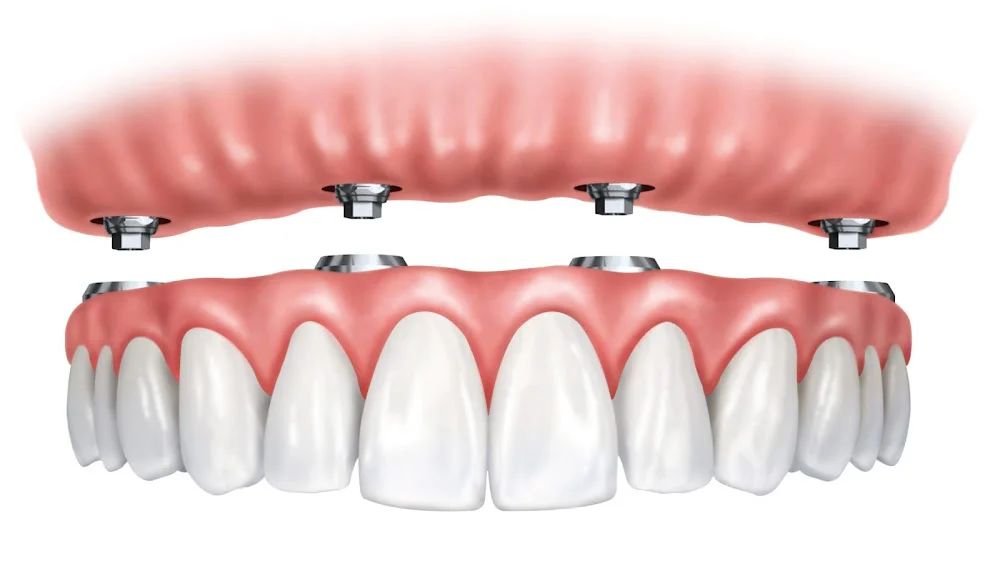 Advanced Dentistry & Implant Center of Scottsdale Picture 7
