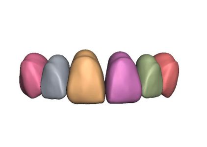 Same Day Dental Crown