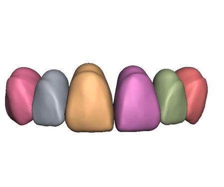 Same Day Dental Crown