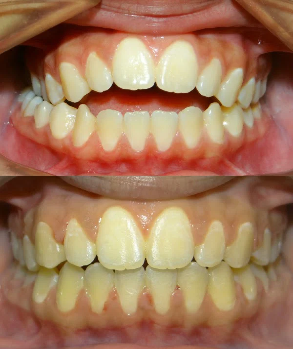 Diamond Braces Orthodontist: Braces & Invisalign 9