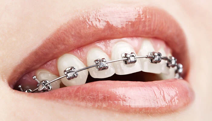 Carpenter Orthodontics- Fred W Carpenter DDS 2