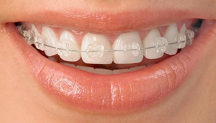 Carpenter Orthodontics- Fred W Carpenter DDS 5