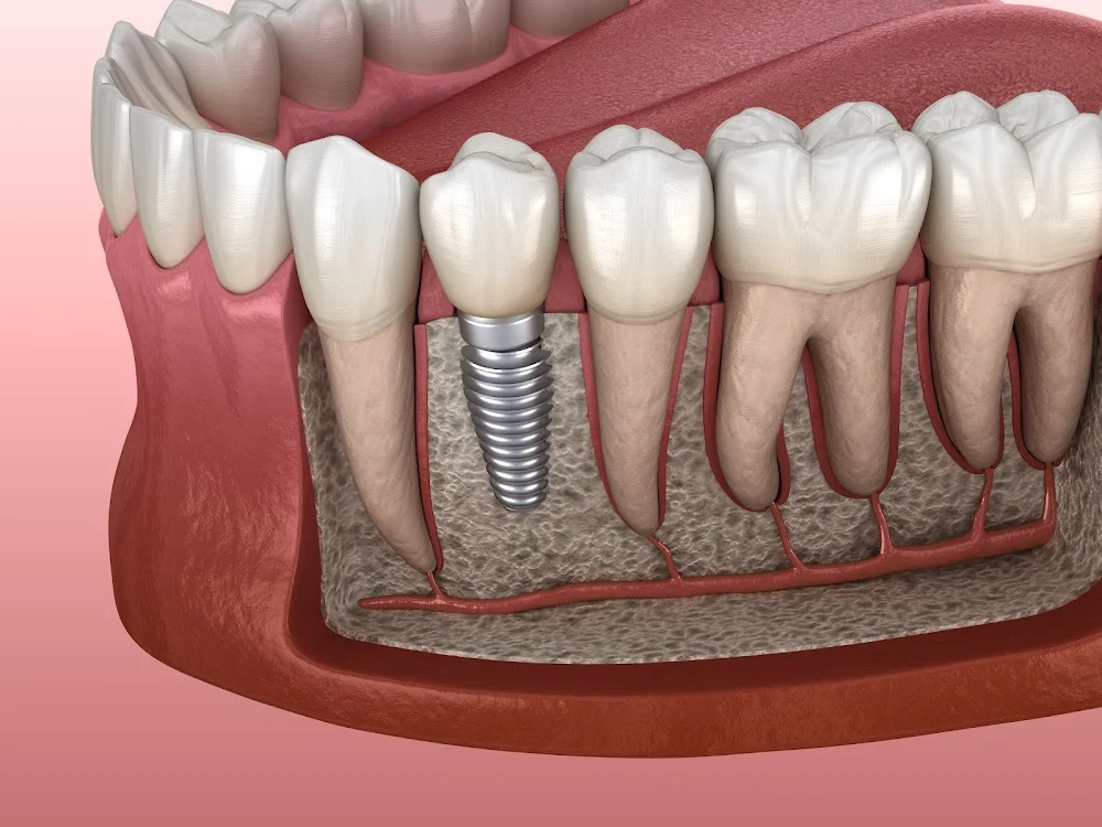 Precision Oral Surgery and Implants 7