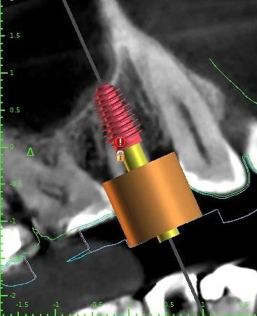 Dental Implant | Crown | Denture 1