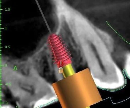 Dental Implant | Crown | Denture