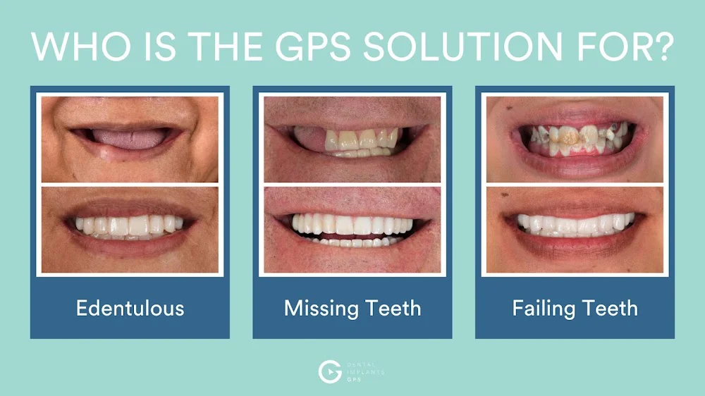 Dental Implants GPS Dana Point 2