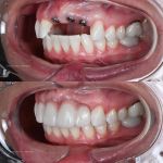 Advanced Prosthodontics & Implant Esthetics