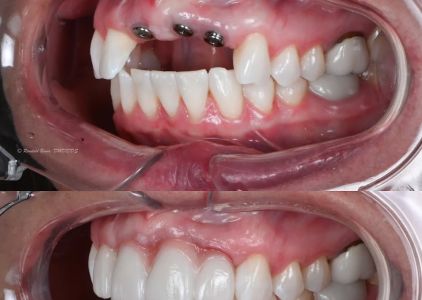 Advanced Prosthodontics & Implant Esthetics
