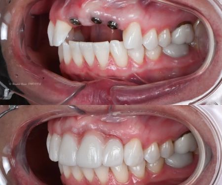 Advanced Prosthodontics & Implant Esthetics