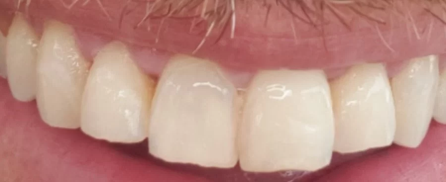 Maui Whitening Orlando 1