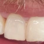 Maui Whitening Orlando