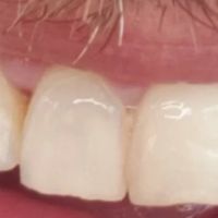 Maui Whitening Orlando ico