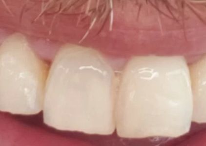 Maui Whitening Orlando