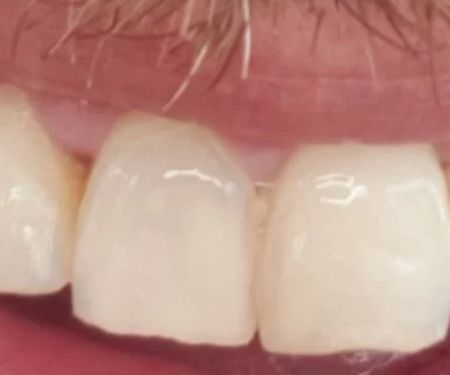Maui Whitening Orlando