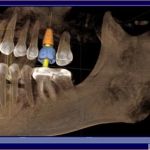 Carolina Implant