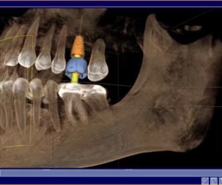 Carolina Implant