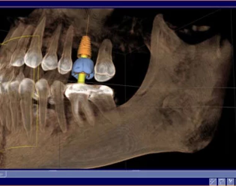 Carolina Implant