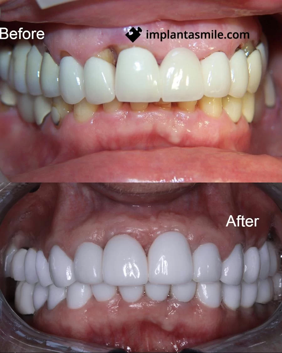 implantasmile.com | Antoine S. Sayegh, DDS 10