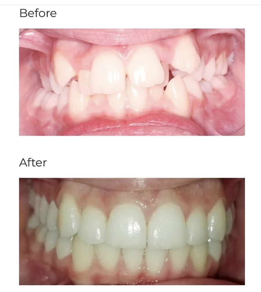 Calismile Orthodontics 6
