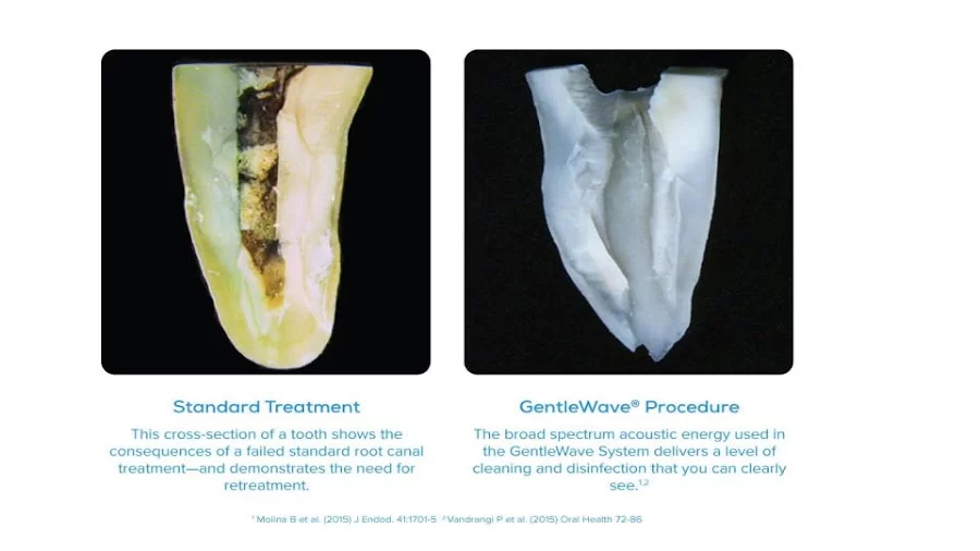 Bauman Endodontics Richard Bauman DMD 2