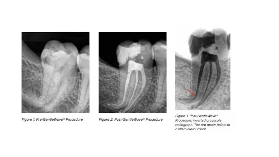 Bauman Endodontics Richard Bauman DMD 1